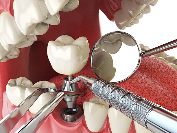 Best Cracked Tooth Emergency Dentist  in Lavonia, GA